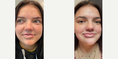 Lower Lip scar revision - Before and after of a lower lip scar revision