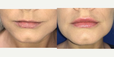35-44 year old woman treated with Lip Augmentation - Lips Lips and more lips. Lips are hot right now. I still try to convince most patients to go a conservative route. We injected this woman's lips over a 2 wk time period to approach it as naturally as possible. It paid off for her. She is looking great.Best,DrC