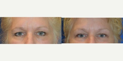 55-64 year old woman treated with Brow Lift - Before and After of a Brow Lift performed by Dr. Almonte.