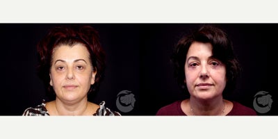 51 year old woman treated with CoolMini to the chin. - 51 year old woman treated with CoolMini to the chin. Photos depict before and 6 months after treatment.