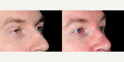 45 year old man treated with Ptosis Surgery - 45 year old man treated with Ptosis Surgery. Photos depict before and one year after surgery.