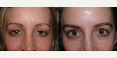 Eyebrow Transplant - Before and after 650 grafts to eyebrows