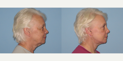 63 year old woman treated with Facelift - This 63 year old patient was treated with Facelift, Necklift, and laser BBL wavelengths.