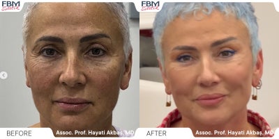 45-54 year old woman treated with Deep Plane Facelift - .