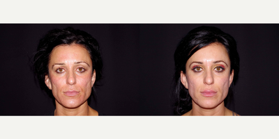 25-34 year old woman treated with Dermabrasion - 31 year old female received dermabrasion to the face for acne scarring; photos depict the patient's results 2 months post-op.