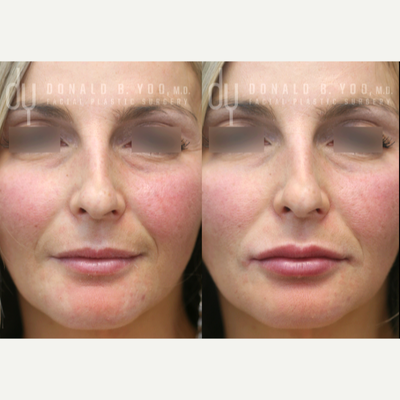 45-54 year old woman treated with Lip Fillers, Restylane Kysse, Vollure, Volbella - Lip augmentation for volume and structure