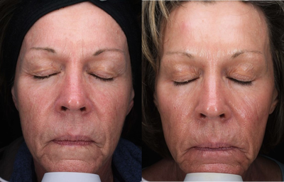 Woman treated with Dermaplaning - Woman treated with Dermaplaning
