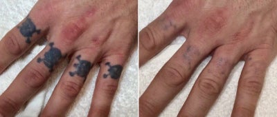 Before and after 4 Enlighten tattoo removal treatments - Just 4 treatments with Enlighten on these four small knuckle tattoos.