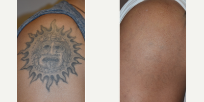 Picosure laser tattoo removal before and after photos, Los Angeles - Did your tattoo seem cooler at 20 than it does at 40? If so, we've got a solution for you. Call today to learn more about laser tattoo removal.