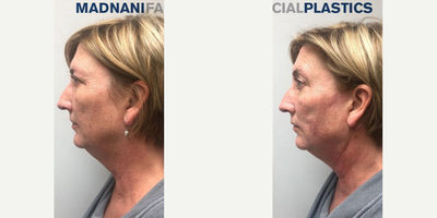 Woman treated with Thread Lift - Woman treated with Thread Lift