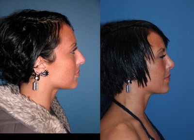 Rhinoplasty - 
	rhinoplasty
