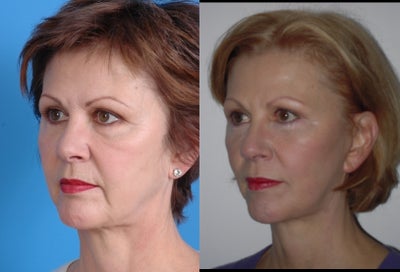 Facelift Results - 
	Lower Facelift (deep plane) with revision lower lid surgery
