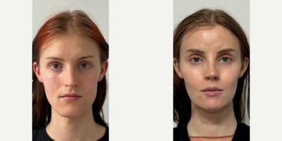 Patient treated with Facial Feminization Surgery - A beautiful before and after of our great patient just 5 months after full FFS. Procedures performed were mandible and forehead contouring, browlift, hairline advancement, rhinoplasty, cheek implants placement. We are so thankful to all of our patients who are willing to share their results to help others make the choice of the right FFS Surgeon! World-leading FFS is in Arlington, VA!