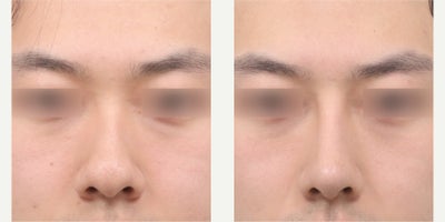 35-44 year old man treated with Asian Rhinoplasty, Rhinoplasty - He had rhinoplasty (hump smoothing, bulbous tip correction, alar reduction, septoplasty, rib cartilage)