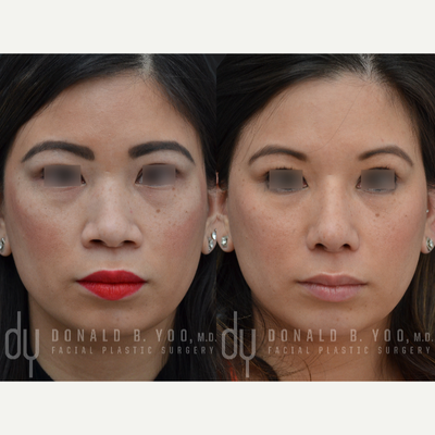 Asian Rhinoplasty with DCF and Alar base modification - Asian Rhinoplasty with DCF and Alar base modification