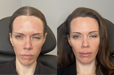 25-34 year old woman treated with Xeomin - 55 units:Glabella: 20 unitsFrontalis: 20 units Crows Feet: 15 units