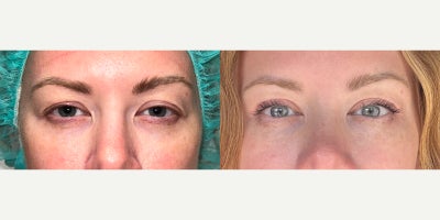 35-44 year old woman treated with Eyelid Surgery, Ptosis Surgery - 6 weeks s/p bilateral upper blepharoplasty and ptosis repair