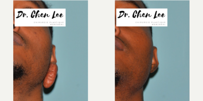 25-34 year old woman treated with Scar Removal - Keloid Removal by Dr Chen Lee at Plastic Surgery Montreal.Excision of left earlobe keloid