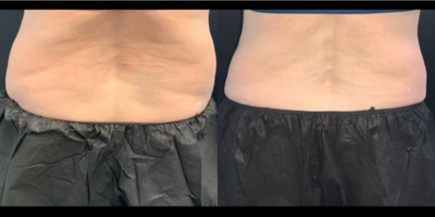 35-44 year old woman treated with truSculpt iD - TruSculpt ID: 6 weeks post treatment at Neem Medical Spa