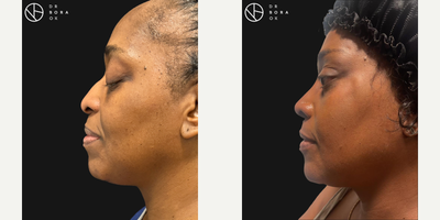 45-54 year old woman treated with African American Rhinoplasty, Buccal Fat Removal, Facelift - My patient had Ethnic Rhinoplasty + Chin Liposuction, Buccal Fat Removal and Temporal / Mid Face Lift.