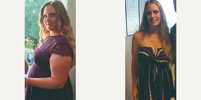 Woman treated with Sleeve Gastrectomy - Woman treated with Sleeve Gastrectomy