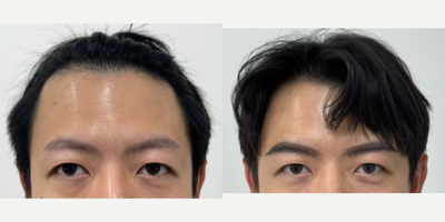 18-24 year old man treated with Eyebrow Transplant - The patient had previous eyebrow tattoo but not happy withit. He waited until the color shade and decided to do the eyebrow transplantation on top.