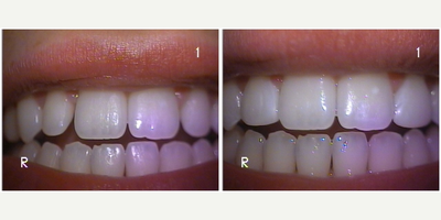 18-24 year old woman treated with Dental Bonding - The patient was unhappy with the shape of her lateral incisors and she wanted a conservative treatment option. You can see that there is space between the lateral incisors and the front teeth. Happily, we were able to close that space without removing any tooth structure in one day.