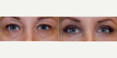 Woman treated with PlasmaPen - Woman treated with PlasmaPen