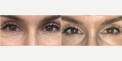 Woman treated with PlasmaPen - Woman treated with PlasmaPen