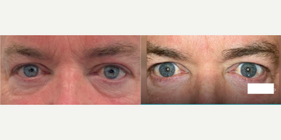 Man treated with PlasmaPen - Man treated with PlasmaPen