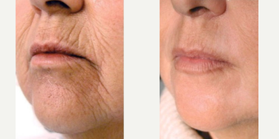 Woman treated with PlasmaPen - Woman treated with PlasmaPen