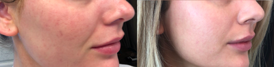 25-34 year old woman treated with Vivace - Vivace