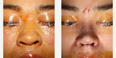 25-34 year old woman treated with Asian Rhinoplasty, DCF Rhinoplasty - 25-34 year old woman treated with DCF rhinoplasty. The patient was unhappy with the appearance of her nose. She felt her nose appear very flat and wide. She also felt her nostrils flare when she smiled. She underwent augmentation of her nasal bridge and tip with a DCF graft. Her nasal projection was improved with use of septal extension graft and nasal tip graft using ear cartilage. She underwent a significant amount of lateral crura steal in order to achieve her tip height. She also underwent bilateral alar base reduction to address her nostril flaring.