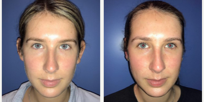 Woman treated with Ear Surgery - Woman treated with Ear Surgery
