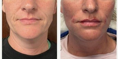 35-44 year old woman treated with Thread Lift, Contour Thread Lift - She presented concerned that her face felt heavier, with deepening nasolabial folds and early jowl formation. We performed a customized thread lift to reposition and elevate the midface and lower face, restoring structural support. This was followed by strategic filler using the fern technique to soften the nasolabial lines while preserving natural movement. The result is a lighter, more contoured appearance with improved jawline definition and balanced facial harmony.