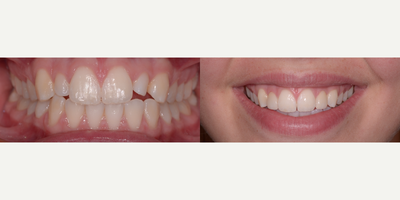 18-24 year old woman treated with Da Vinci Veneers - Dental Veneers using CAD CAM 3D Technology