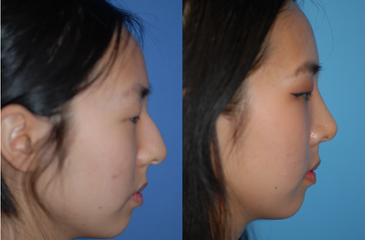 Woman treated with Rhinoplasty - A heavy bump and droopy tip are corrected with rhinoplasty