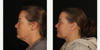 45-54 year old woman treated with Facelift, Neck Lift, Facial Fat Transfer, Double Eyelid Surgery, Eyelid Surgery - Our patient is 2 months out from a deep plane face and neck lift, upper and lower blepharoplasty, and facial fat grafting and she is healing beautifully! Thank you to her for allowing us to share! My favorite part is the new neck contour. To achieve this, we performed deep neck sculpting - partially removing submandibular glands and deep volume and tightening the muscles in the neck. Then we lifted and volumized the lateral neck and face. The blepharoplasty and fat grafting also help rejuvenate her eyes, temples and cheeks. As time passes swelling below her neck will continue to improve and the incisions will get even less perceptible.
