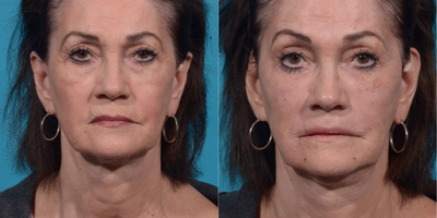 65-74 year old woman treated with Liquid Facelift - Radiesse to lower lid cheek junction and nasolabial foldsJuvederm to Marionette linesVolbella to lip smokers lines on upper and lower lip