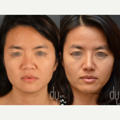 25-34 year old woman treated with Asian Rhinoplasty - Before and After Asian rhinoplasty with rib cartilage, diced cartilage fascia (DCF) and alar base reduction. 2 months post op.