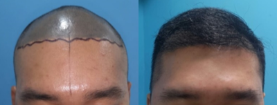 25-34 year old man treated with Scalp Micropigmentation - The patient has got SMP prior to the hair transplantation.After SMP, FUE hair transplantation was done on top at 3500 grafts.