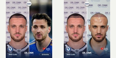 25-34 year old man treated with DHI Hair Transplant - For Italian football star Feredico Gatti, we performed a DHI hair transplant with a custom-designed hairline tailored specifically to his facial anatomy and natural features.The treatment plan was carefully designed to create a natural-looking result that complements his facial proportions while ensuring optimal density and long-term hair growth.Using the advanced DHI technique, we achieved a seamless and natural hairline, preserving his unique appearance while enhancing overall hair coverage.