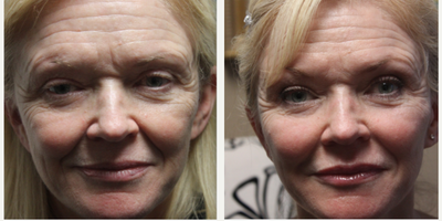 65-74 year old woman treated with Vampire Facelift - Vampire Facelift (microneedling and PRP via cannula and superficial smear) and cheek filler.