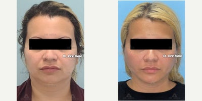 25-34 year old woman treated with Buccal Fat Removal, Extended Chin Liposuction, Mini FaceTite, NeckTite, Morpheus8, Facial Femi - 25-34 year old woman treated with Buccal Fat Removal, Extended Chin Liposuction, Mini FaceTite, NeckTite, Morpheus8, Facial Feminization ( Cheekbone Fillers, Chin Filler, NLF Fillers)
