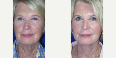Woman treated with Nonsurgical Facelift, Nonsurgical Neck Lift - Check out this beautiful patient who came to us seeking #FacialRejuvenation to address her sagging jowls, drooping skin in her neck, and deep wrinkles around her mouth. Swipe to see results.