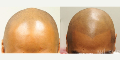 25-34 year old man treated with Scalp Micropigmentation - Scalp Micropigmentation