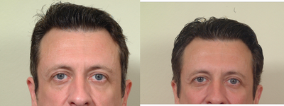 Cheek implants - Medpore cheek implants placed though an incision inside the mouth.
