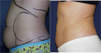 38 year old female requesting liposuction to define her abs - Before:  38 year old female with stubborn belly fat despite exercise. &nbsp;After:  1 year after Smart Lipo Triple of the upper and lower abdomen.&nbsp;