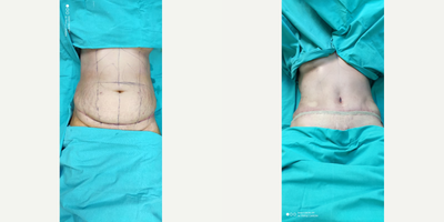 55-64 year old woman treated with Tummy Tuck - Tummy-tuck with side liposuctio