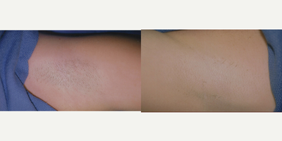 25-34 year old woman treated with Laser Hair Removal - Laser hair removal